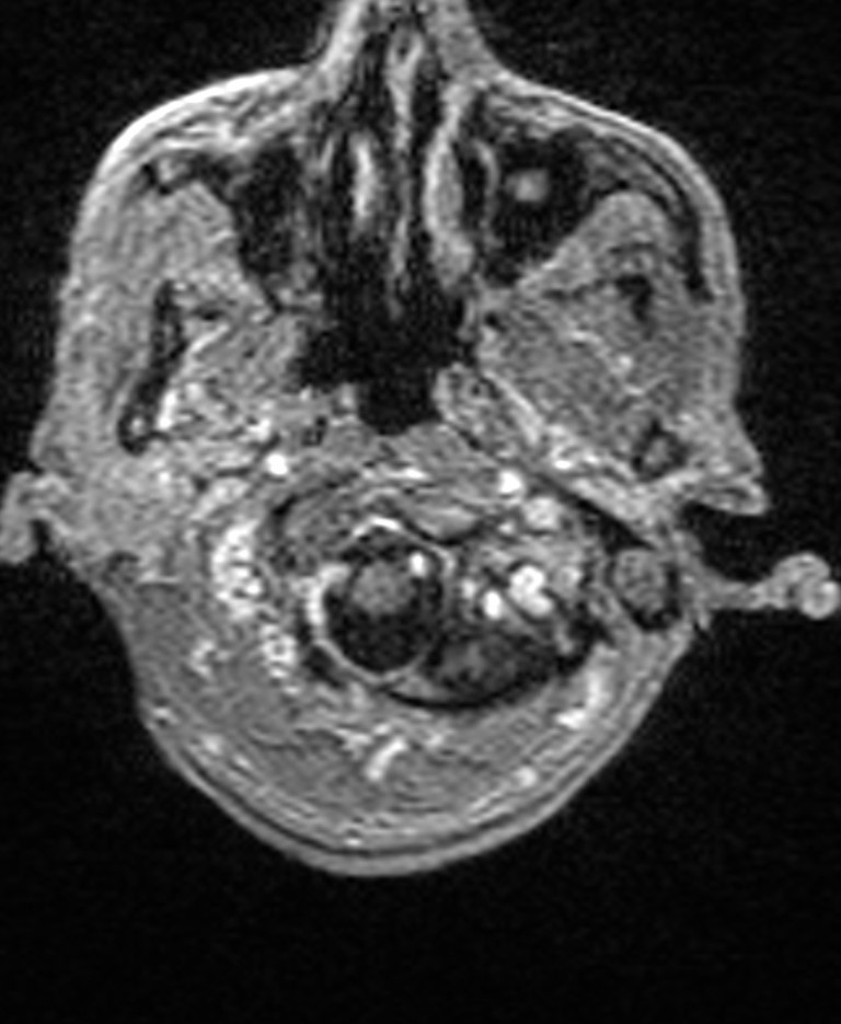 Brain abscess with dual rim sign (Radiopaedia 87566-103938 Axial T1 C+ 19).jpg