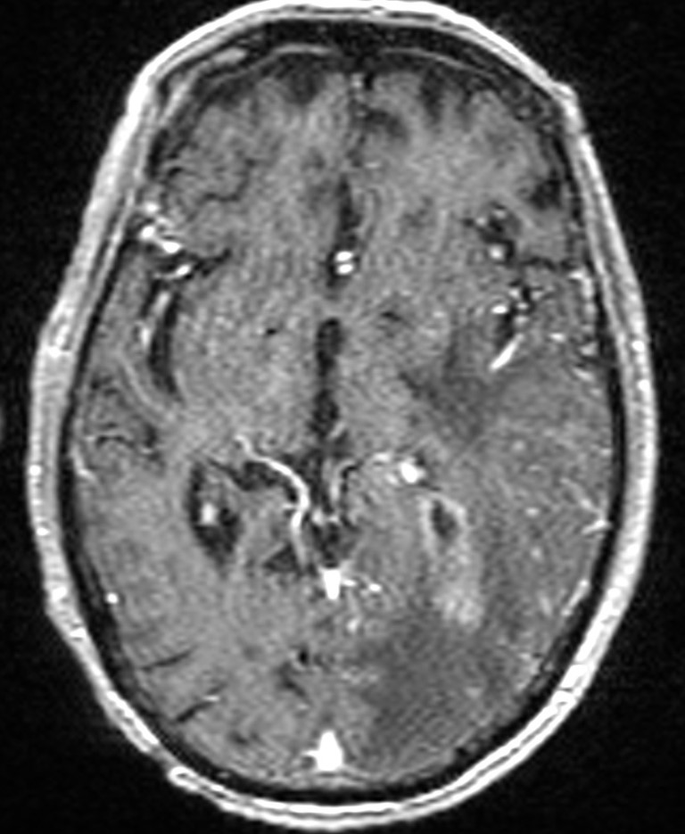 Brain abscess with dual rim sign (Radiopaedia 87566-103938 Axial T1 C+ 80).jpg