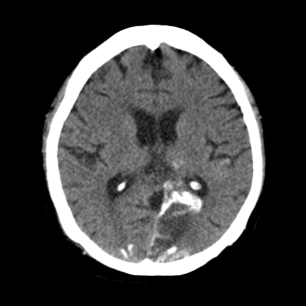 Brain cortical laminar necrosis (Radiopaedia 25822-25971 Axial non-contrast 25).jpg