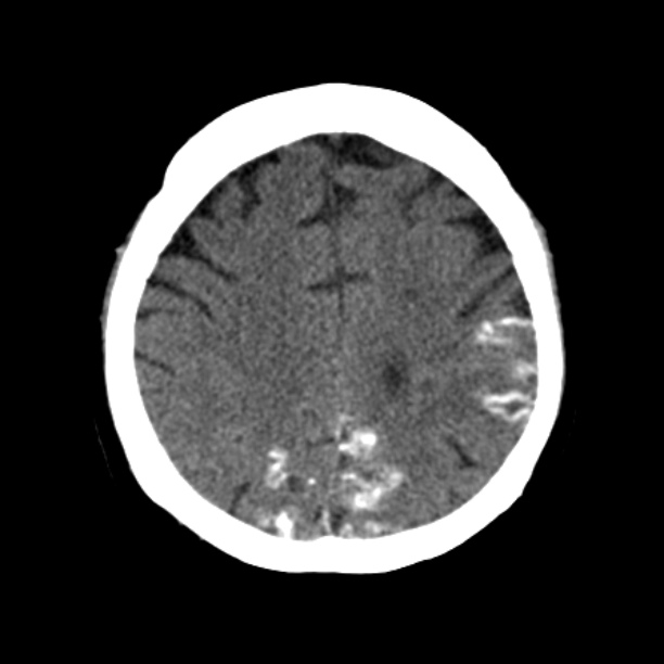 Brain cortical laminar necrosis (Radiopaedia 25822-25971 Axial non-contrast 32).jpg