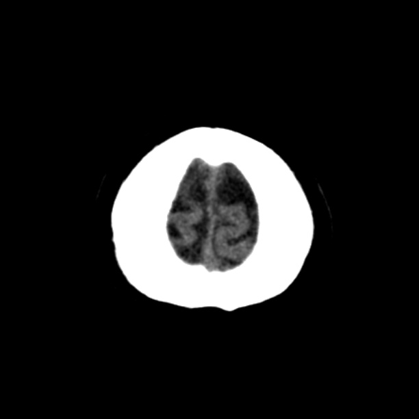 Brain cortical laminar necrosis (Radiopaedia 25822-25971 Axial non-contrast 47).jpg
