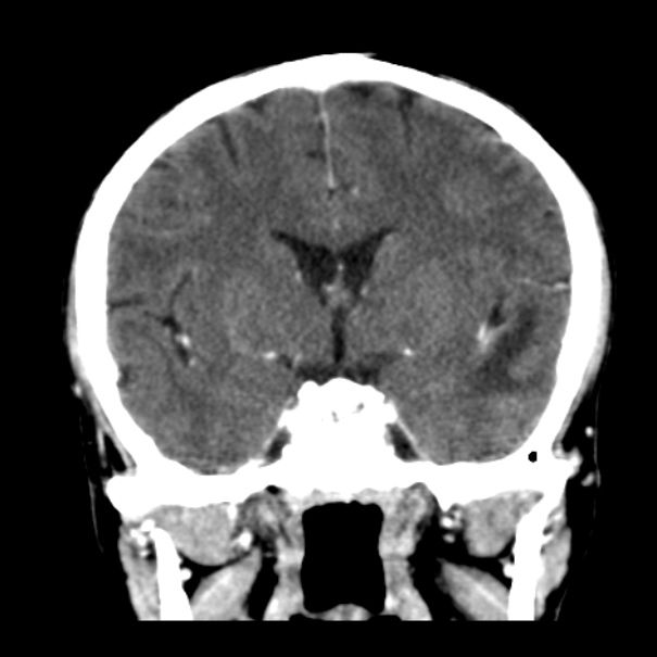 Brain metastases from lung cancer (Radiopaedia 24480-24781 Coronal C+ delayed 29).jpg