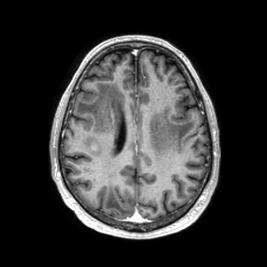 File:Brain metastases from lung cancer (Radiopaedia 83839-99028 Axial T1 C+ 44).jpg