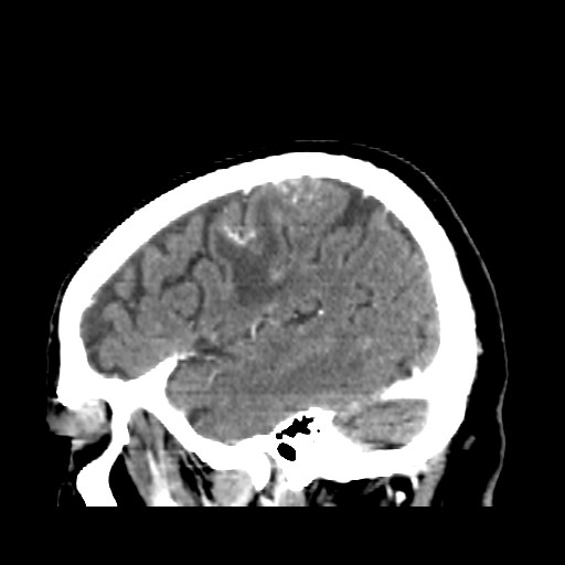 Brain metastasis (Radiopaedia 42617-45760 D 46).jpg
