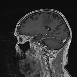 Brain metastasis (Radiopaedia 42617-45761 Sagittal T1 C+ 37).jpg