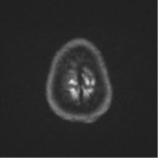Brain metastasis (large cystic mass) (Radiopaedia 47497-52107 Axial DWI 54).png