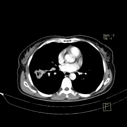 Brain metastasis as initial presentation of non-small cell lung cancer (Radiopaedia 65122-74127 A 27).jpg