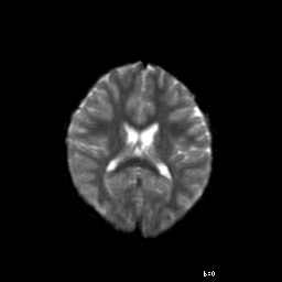 File:Brainstem ganglioglioma (Radiopaedia 10763-11224 Axial DWI 8).jpg