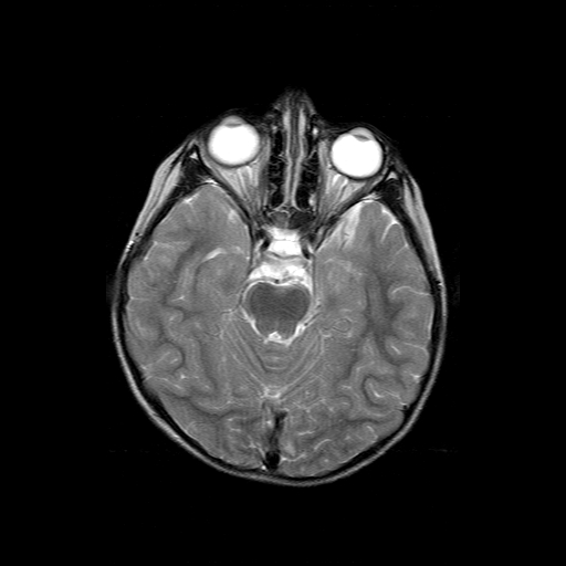 File:Brainstem ganglioglioma (Radiopaedia 10763-11224 Axial T2 13).jpg