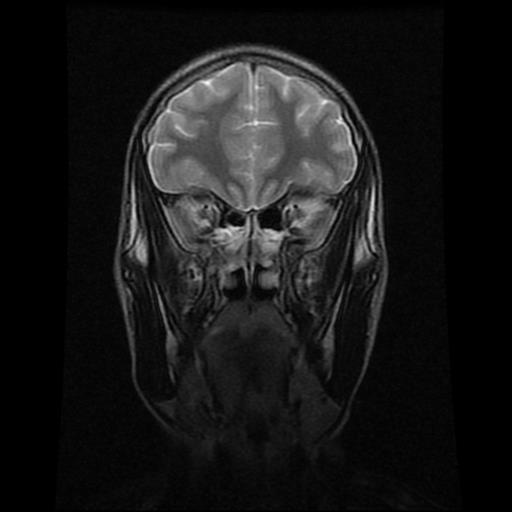 File:Brainstem glioma (Radiopaedia 30923-31624 Coronal T2 16).jpg