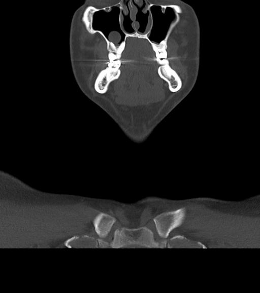 Branchial cleft cyst (Radiopaedia 31167-31875 Coronal bone window 18).jpg
