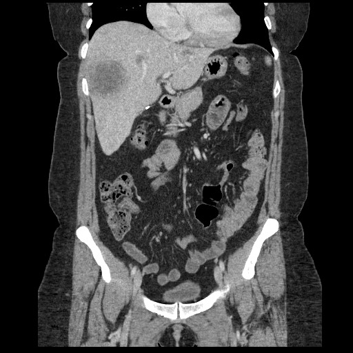 File:Breast cancer pseudocirrhosis after chemotherapy (Radiopaedia 65407-74456 B 35).jpg