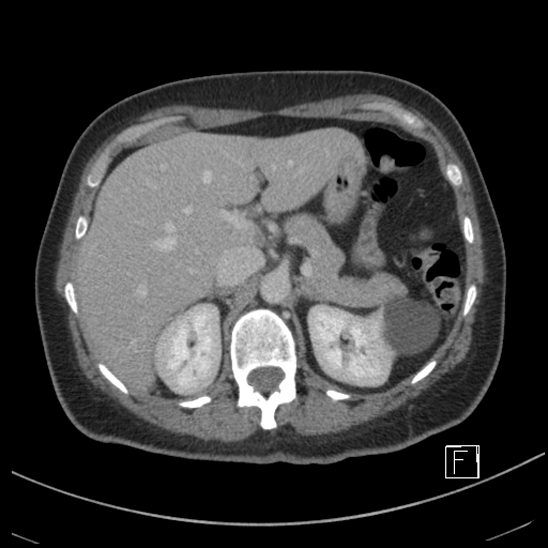 File:Breast metastases from renal cell cancer (Radiopaedia 79220-92225 C 25).jpg
