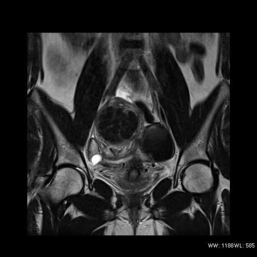 File:Broad ligament fibroid (Radiopaedia 49135-54241 Coronal T2 13).jpg