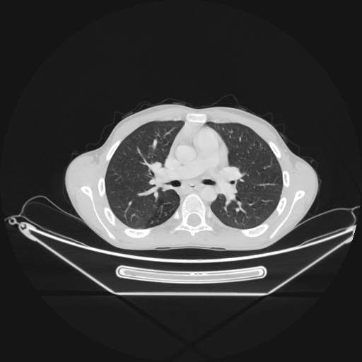 Bronchial carcinoid tumor (Radiopaedia 57187-64090 Axial lung window 31).jpg