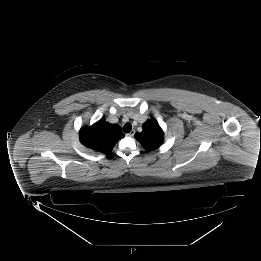 Bronchial carcinoid tumor (Radiopaedia 78272-90870 C 26).jpg