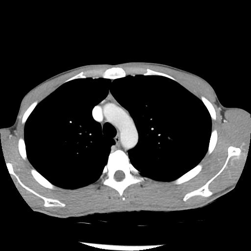 Bronchial carcinoid tumor causing right lower lobe collapse (Radiopaedia 83495-98594 A 13).jpg