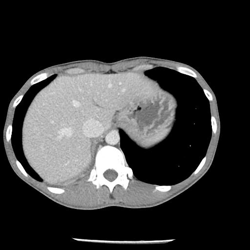 Bronchial carcinoid tumor causing right lower lobe collapse (Radiopaedia 83495-98594 A 49).jpg
