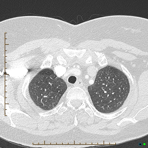 Bronchial diverticula (Radiopaedia 79512-92676 Axial lung window 21).jpg