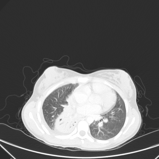 Bronchial mucoepidermoid carcinoma (Radiopaedia 57023-63895 Axial lung window 62).jpg