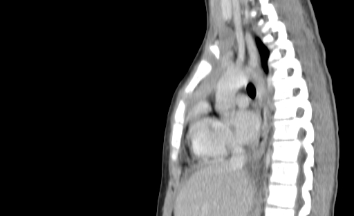 Bronchial mucoepidermoid carcinoma (Radiopaedia 57023-63895 Sagittal 124).jpg