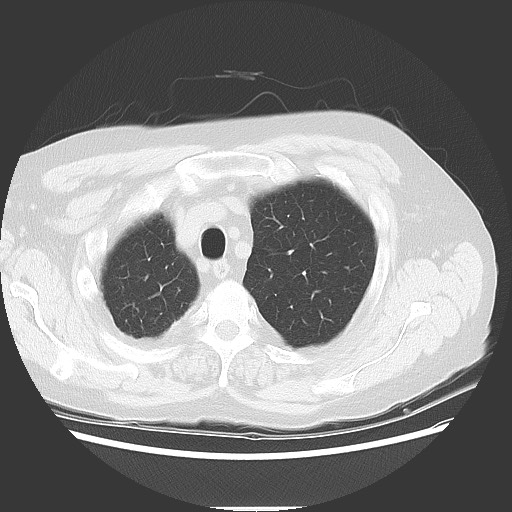 Bronchial stenosis - lung transplant (Radiopaedia 73133-83848 Axial lung window 13).jpg