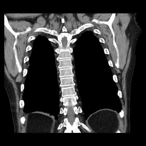 Bronchial stenosis - lung transplant (Radiopaedia 73133-83848 Coronal non-contrast 51).jpg