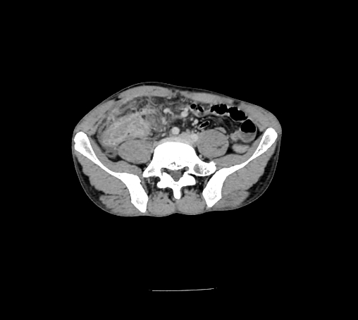 File:Bronchiectasis in Crohn disease (Radiopaedia 60311-67977 B 120).jpg