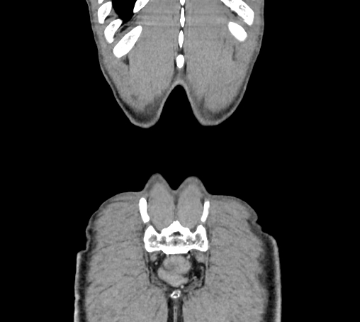 Bronchiectasis in Crohn disease (Radiopaedia 60311-67977 C 84).jpg
