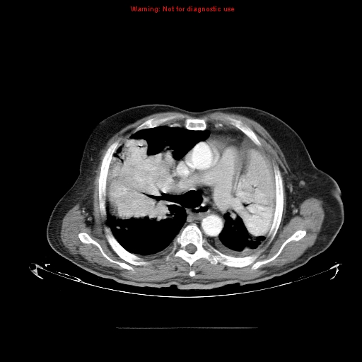 File:Bronchioloalveolar carcinoma (Radiopaedia 9272-9955 A 12).jpg