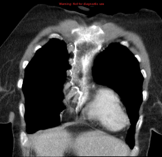 Bronchoalveolar carcinoma (BAC) (Radiopaedia 13436-13392 E 11).jpg