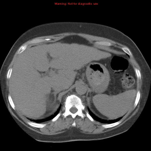 Bronchoalveolar carcinoma (Radiopaedia 13224-13233 Axial non-contrast 46).jpg