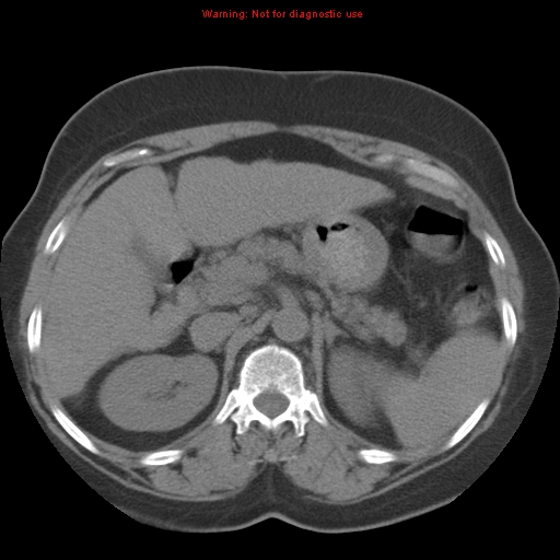Bronchoalveolar carcinoma (Radiopaedia 13224-13233 Axial non-contrast 51).jpg