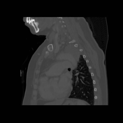 Bronchogenic carcinoma (Radiopaedia 73497-84262 Sagittal bone window 98).jpg