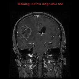 File:Bronchogenic carcinoma brain metastasis (Radiopaedia 9286-9969 Coronal T1 12).jpg