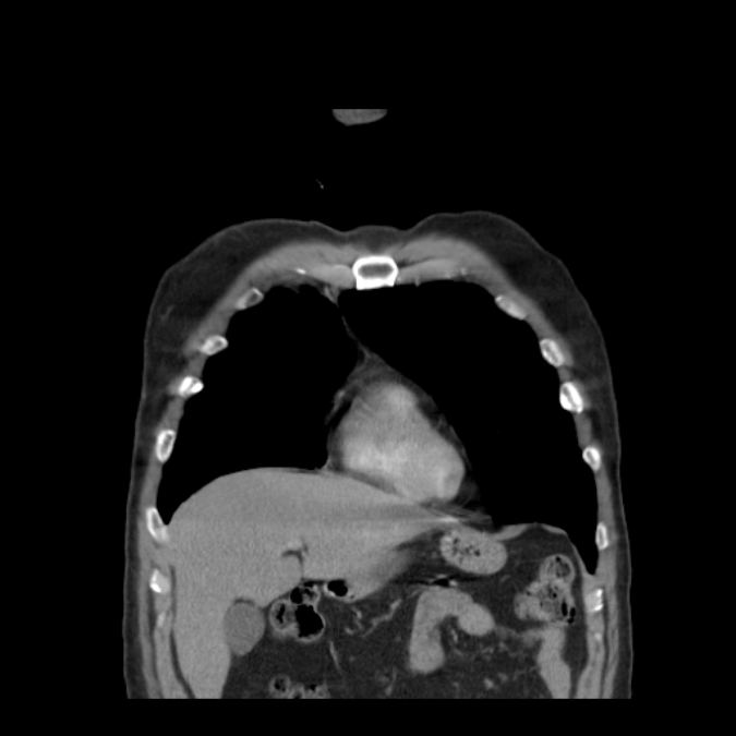Bronchogenic carcinoma with upper lobe collapse (Radiopaedia 29297-29726 D 15).jpg