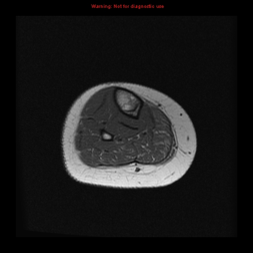 File:Brown tumor (Radiopaedia 12318-12597 Axial T1 29).jpg