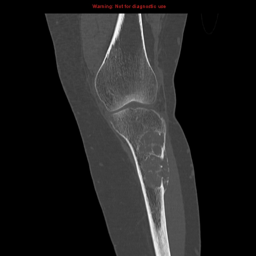 File:Brown tumors (Radiopaedia 9666-10291 Coronal bone window 10).jpg
