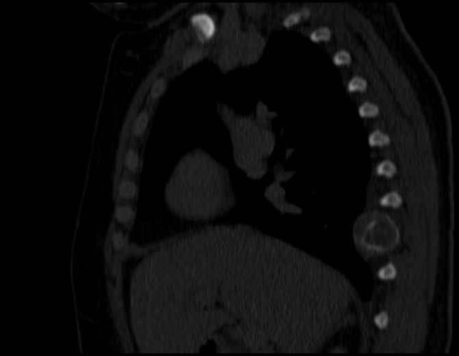 Brown tumors compressing the spinal cord (Radiopaedia 68442-77988 Sagittal bone window 24).jpg