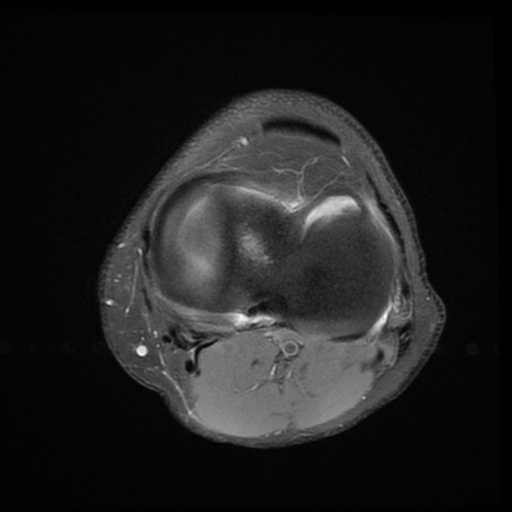 File:Bucket-handle meniscus tear (Radiopaedia 65700-74809 Axial PD fat sat 19).jpg