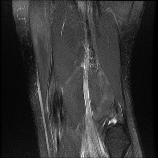 File:Bucket-handle meniscus tear (Radiopaedia 65700-74809 Coronal T2 fat sat 3).jpg