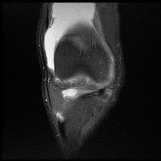 File:Bucket handle tear - medial meniscus (Radiopaedia 69245-79026 Coronal PD fat sat 5).jpg