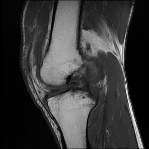 File:Bucket handle tear - medial meniscus (Radiopaedia 69245-79026 Sagittal T1 9).jpg
