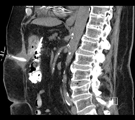Buried bumper syndrome - gastrostomy tube (Radiopaedia 63843-72577 Sagittal Inject 56).jpg