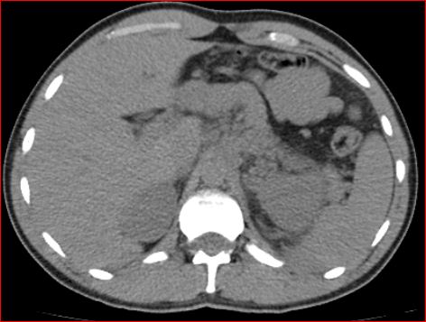 File:Burned-out testicular choriocarcinoma (Radiopaedia 32822-34040 Axial non-contrast 2).jpg