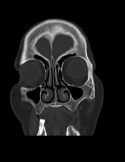 Burnt-out meningioma (Radiopaedia 51557-57337 Coronal bone window 6).jpg