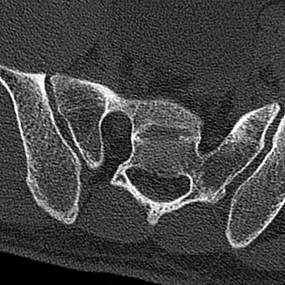 Burst fracture (Radiopaedia 53373-59357 Axial bone window 76).jpg