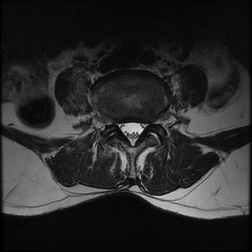File:Burst fracture - lumbar spine (Radiopaedia 72877-83541 Axial T2 14).jpg
