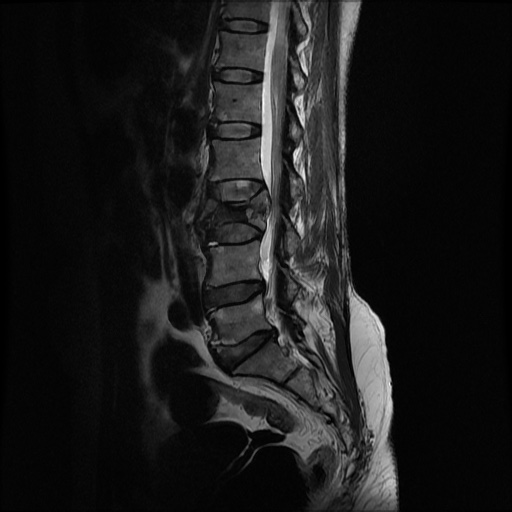 File:Burst fracture - lumbar spine (Radiopaedia 72877-83541 Sagittal T2 4).jpg