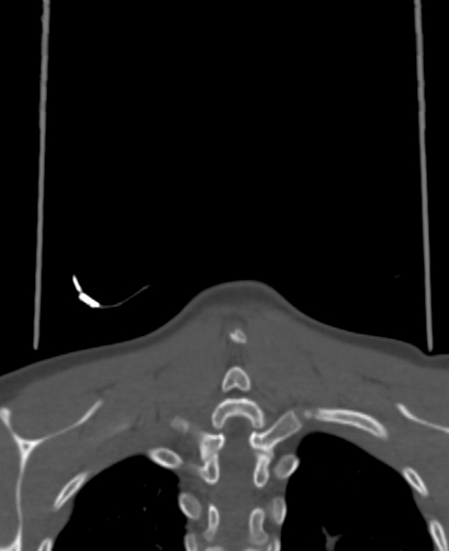Butterfly vertebra (Radiopaedia 77903-90209 Coronal bone window 95).jpg